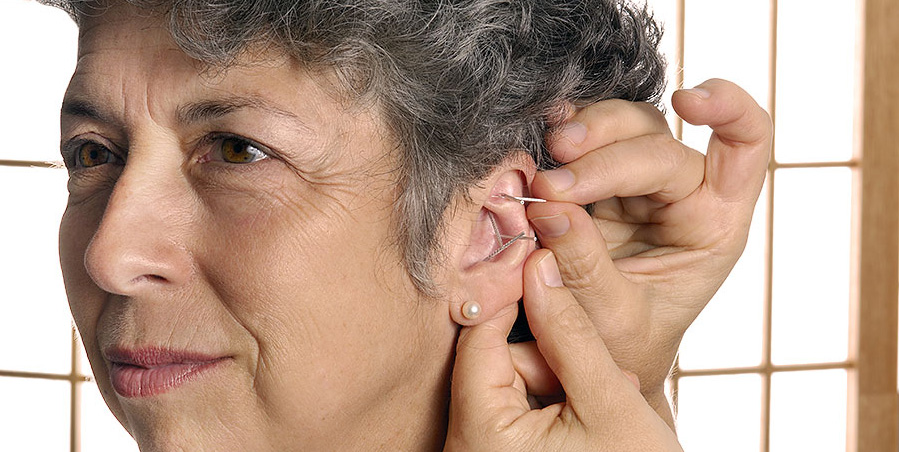 applying needles to a woman's ear